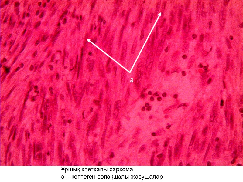 Ұршық клеткалы саркома а – көптеген сопақшалы жасушалар